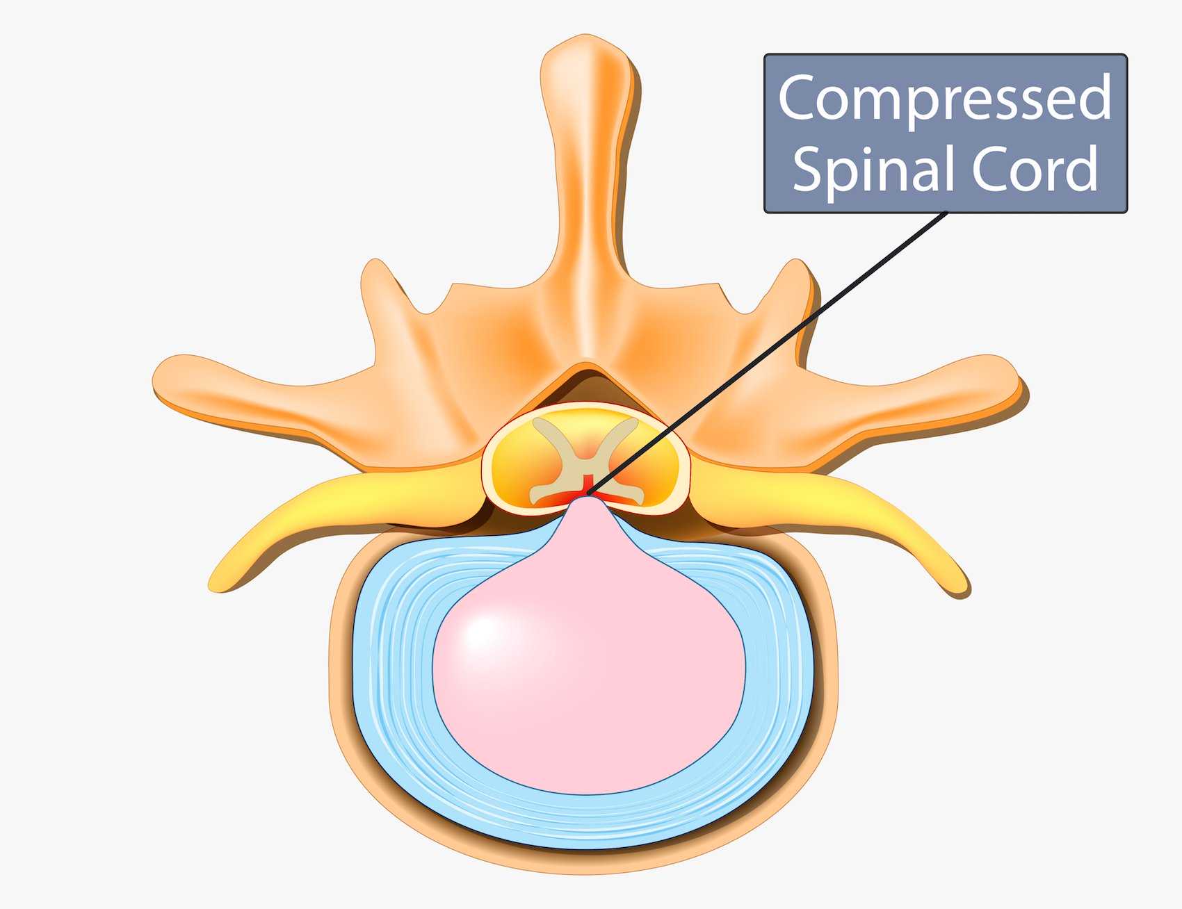 Central Canal Stenosis Compressed Spinal Cord