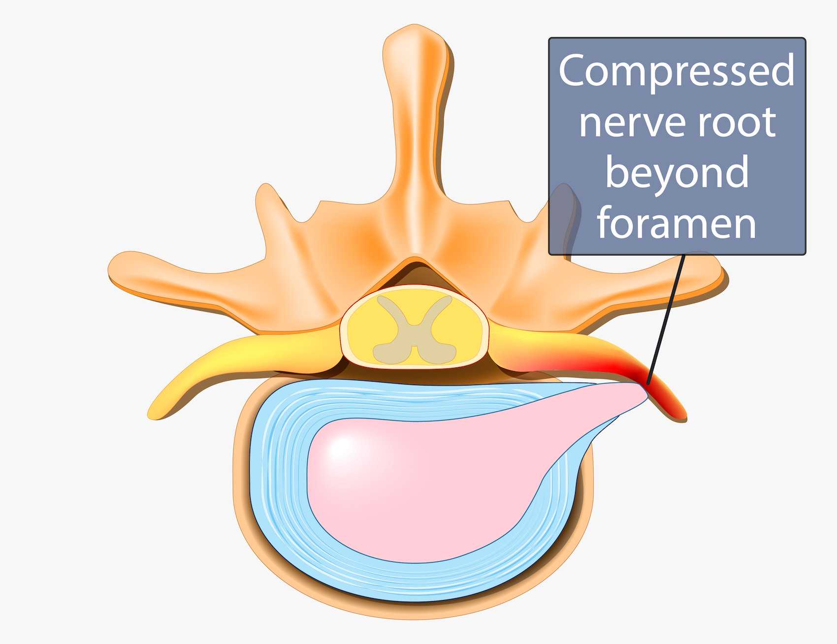 Far Lateral Stenosis Compressed Nerve Root