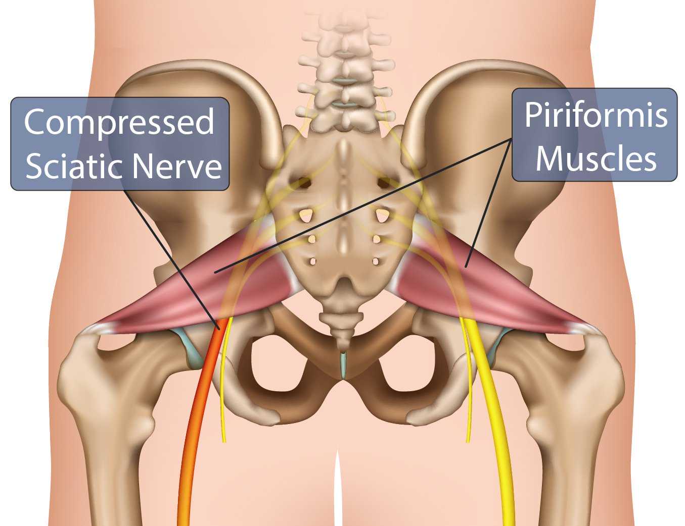 Piriformis Muscles Compressed Nerve