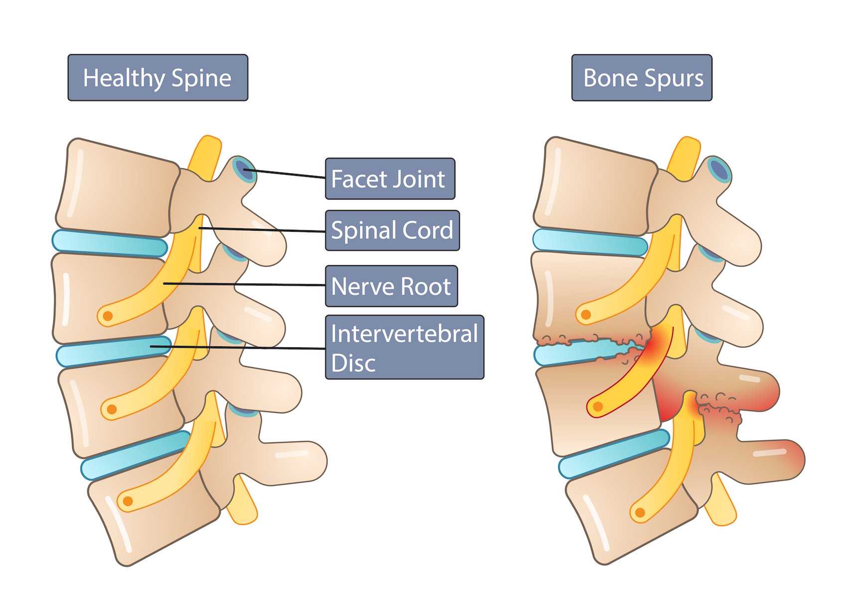 Bone Spurs Symptoms And Causes What Is A Bone Spur Mnc 0295