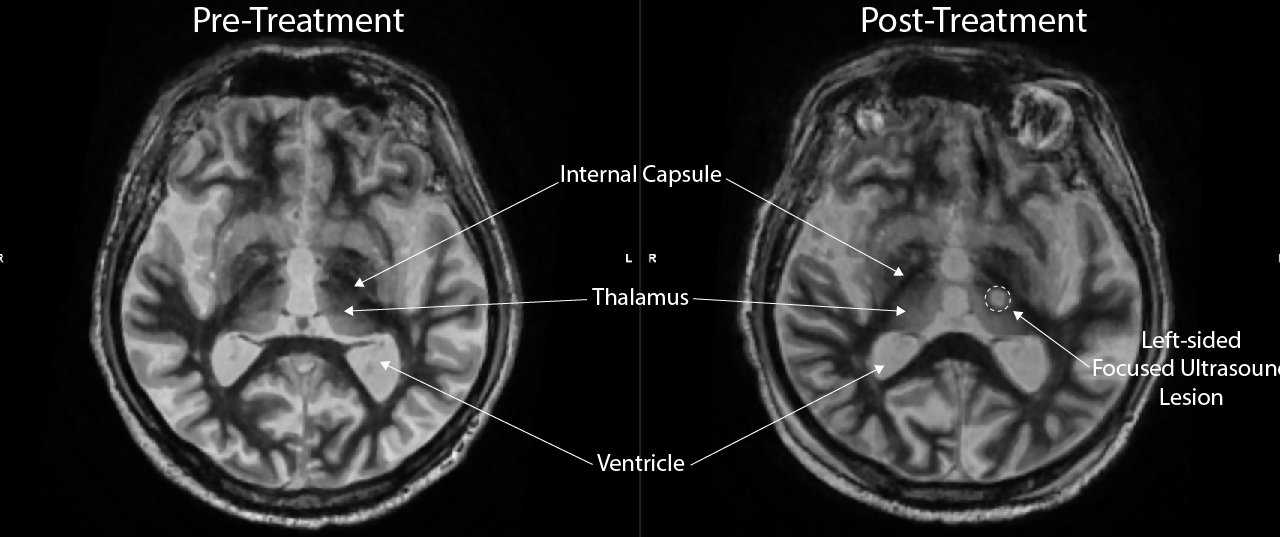 Focused Ultrasound Treatment in Miami Florida