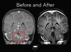 medulloblastoma-before-and-after-treatment
