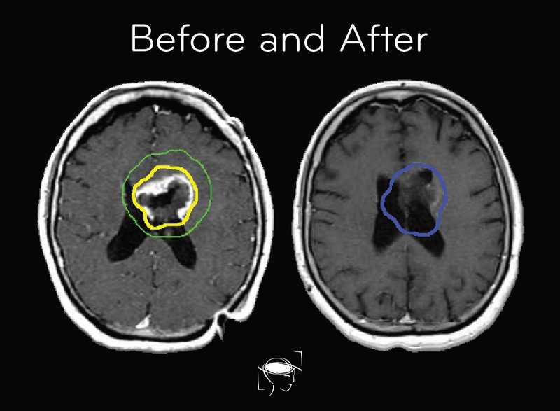 Brain Tumor Types Glioblastoma Meningioma And More 