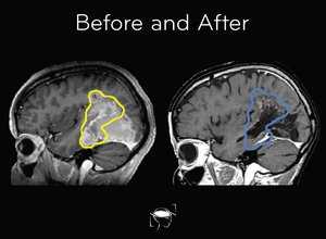 glioblastoma-before-and-after-treatment