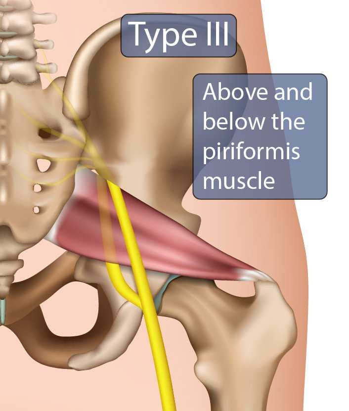 Type III Sciatic Nerve