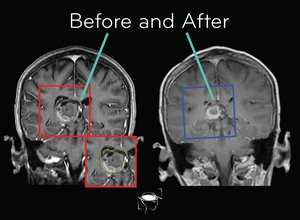 astrocytoma-before-and-after-treatment