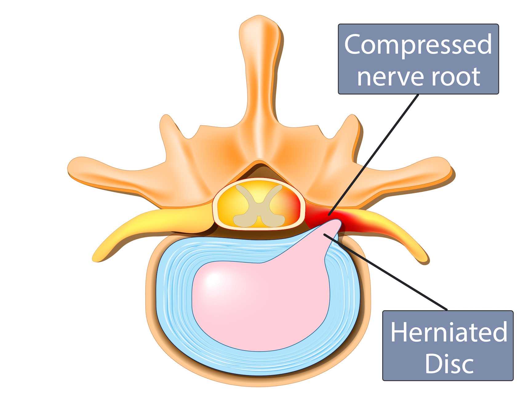 Herniated Disc Anatomy