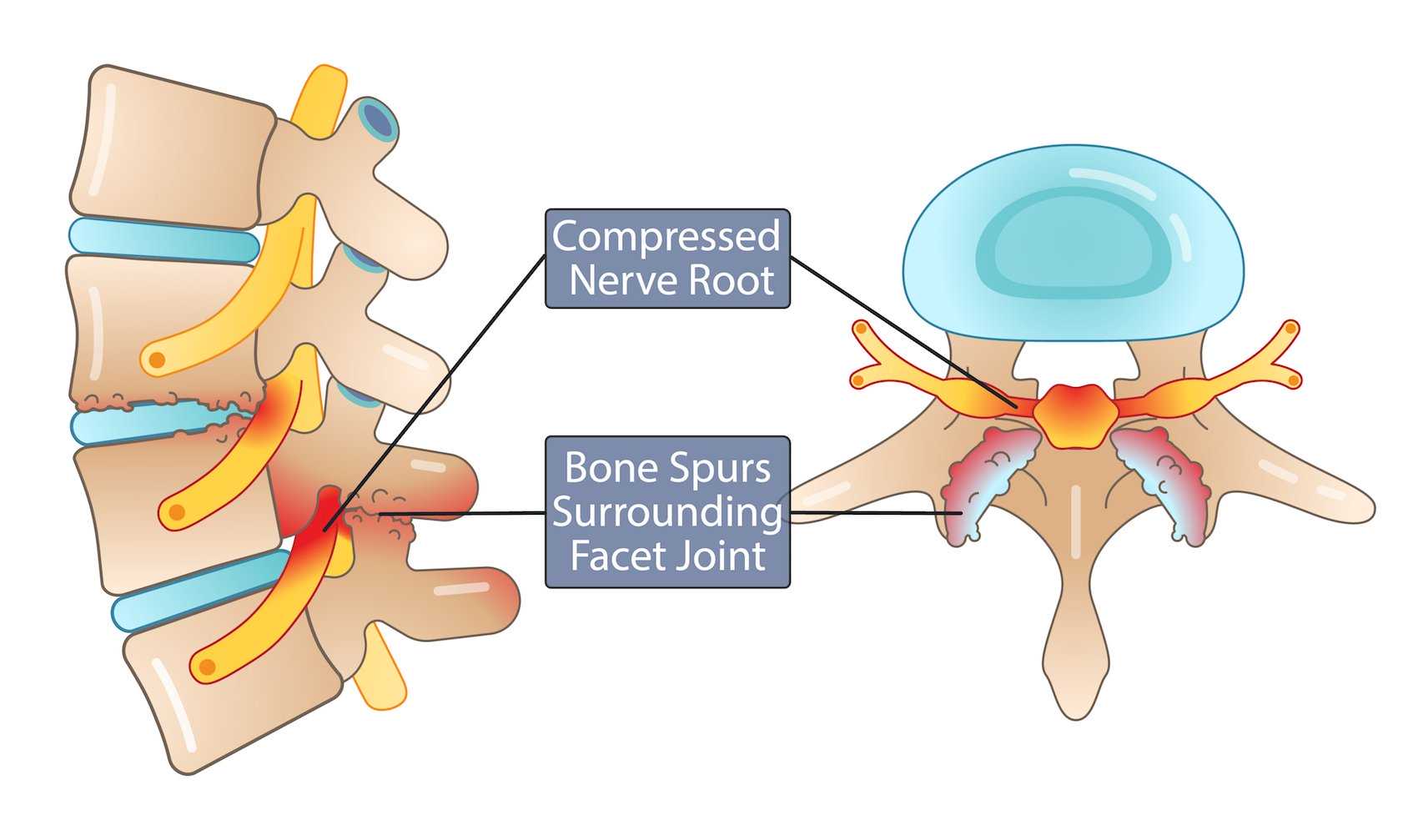 Facet Joint Syndrome Treatment - Compresses nerve root
