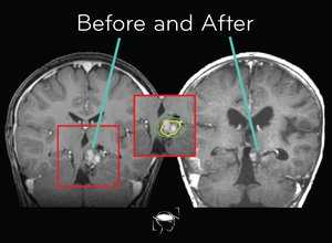 glioma-before-and-after-treatment