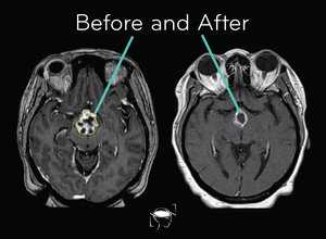craniopharyngioma-before-and-after-treatment
