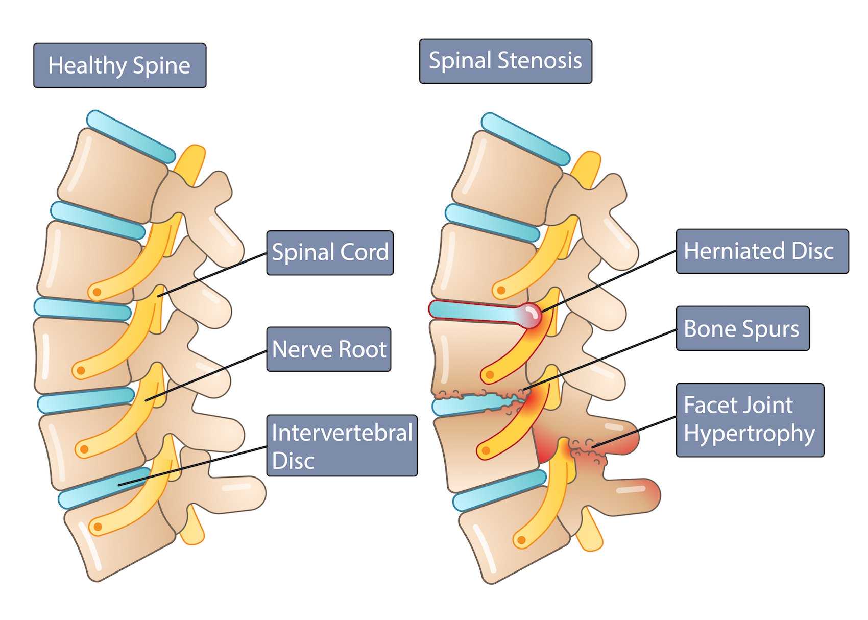 Spinal Stenosis Versus Healthy Spine Anatomy