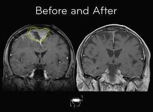 meningioma-before-and-after-treatment