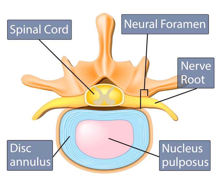 South Florida Neurosurgery - What is a herniated disk? It occurs