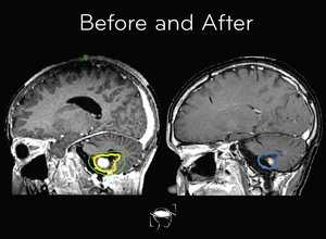 astrocytoma-before-and-after-treatment