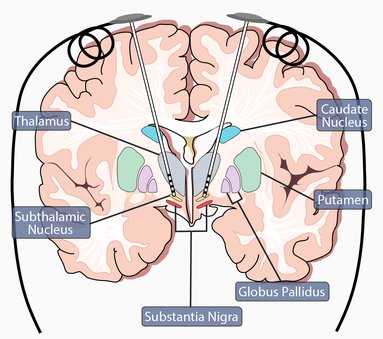 DBS Implanted in Brain (Subthalamic Nucleus)