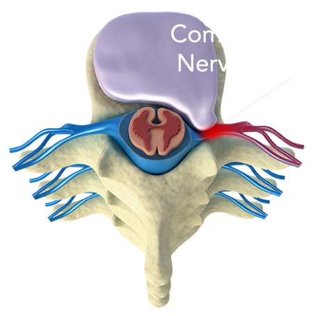RADICULOPATHY Herniated Disc