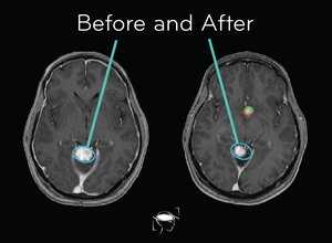 hemangioblastoma-before-and-after-treatment