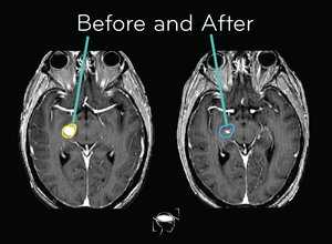 cns-lymphoma-before-and-after-treatment