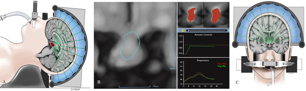 Focused Ultrasound