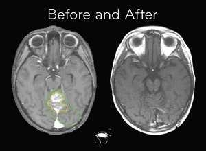 medulloblastoma-before-and-after-treatment