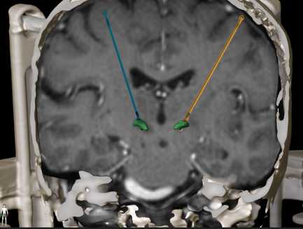 Parkinson's Disease Treatment in Miami | MNC