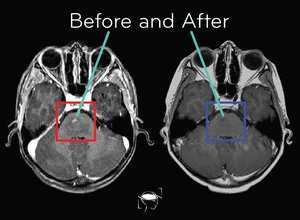 glioma-before-and-after-treatment