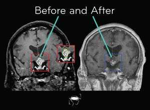 craniopharyngioma-before-and-after-treatment