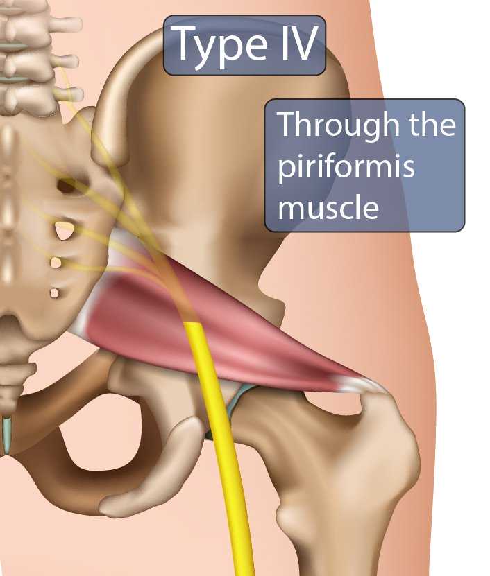 Type IV Sciatic Nerve