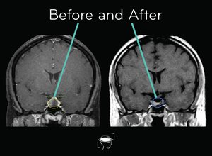 pituitary-tumor-before-and-after-treatment