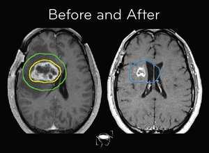 glioblastoma-before-and-after-treatment