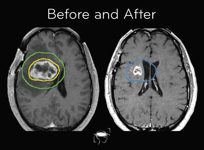 Brain Tumor Types, Glioblastoma, Meningioma & More