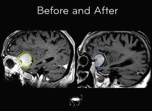 meningioma-before-and-after-treatment