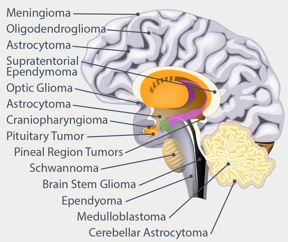 case study 69 brain tumor