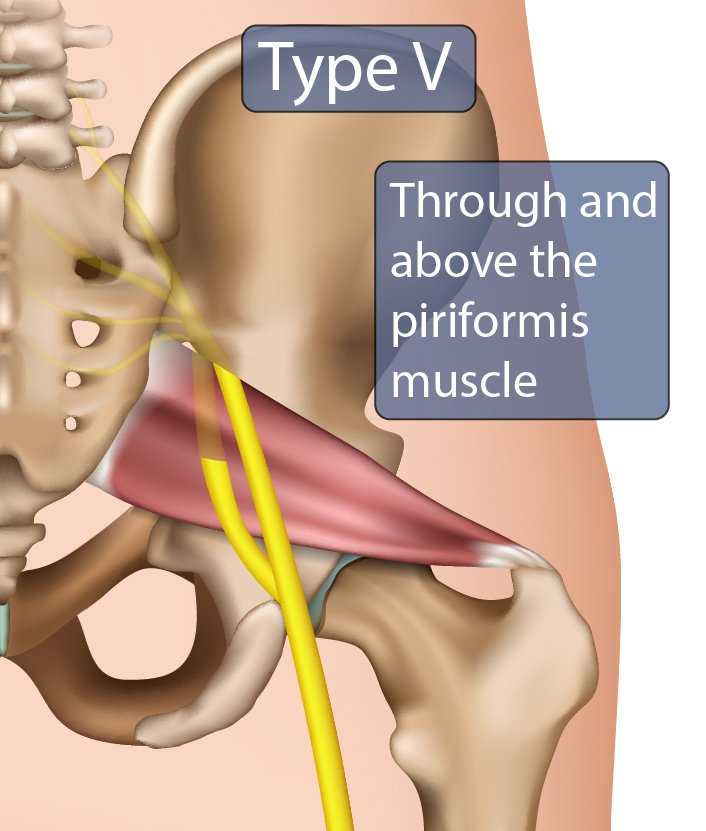 Type V Sciatic Nerve