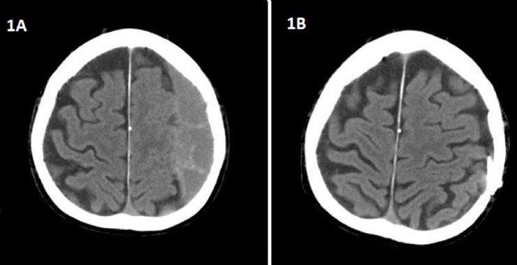 Is Subdural Peritoneal Shunt Placement an Effective Tool for the Management of Recurrent/Chronic Subdural Hematoma?
